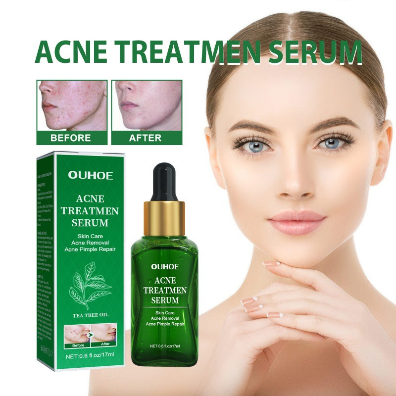 OUHOE Anti-Acne Facial Serum for Oil Control and Pores